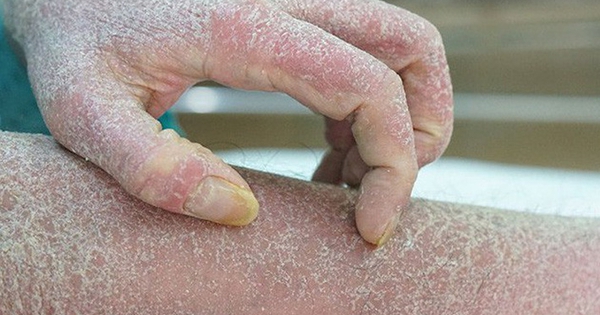 Vì sao căng thẳng, stress khiến bệnh vảy nến càng trầm trọng?