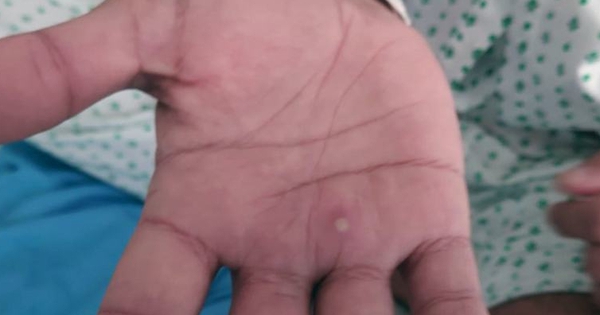 Ai có nguy cơ cao mắc bệnh đậu mùa khỉ?