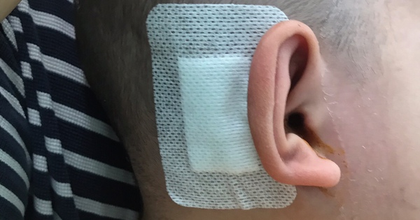 Bé trai điếc bẩm sinh nghe được nhờ cấy ốc tai