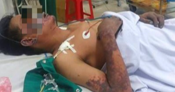 Nhiễm liên cầu khuẩn lợn, người đàn ông bán thịt nguy kịch