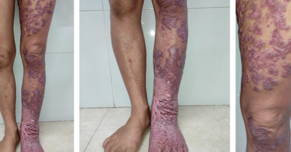 Nhiễm loại nấm da "bị lãng quên", chân người phụ nữ sần sùi như vỏ cây