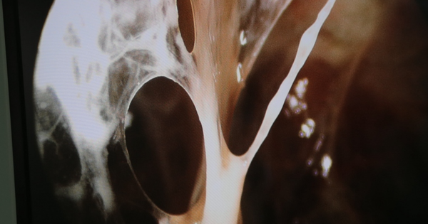 Hai bệnh nhân có phổi đông đặc, xơ hóa nghi do di chứng COVID-19