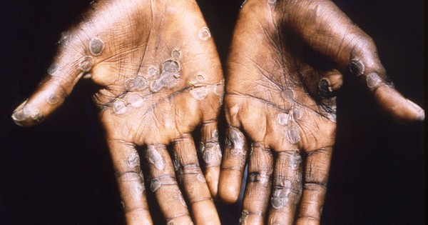 Monkeypox has spread to 11 countries