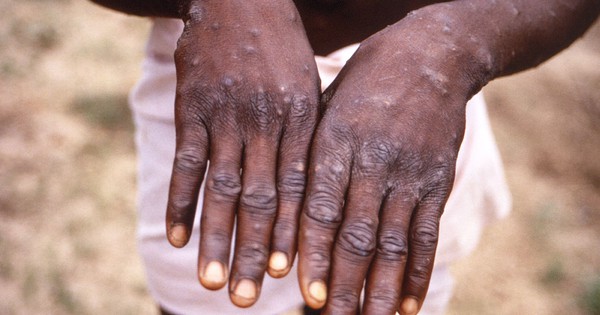 Monkeypox is spreading “in an unusual way” in the US and Europe