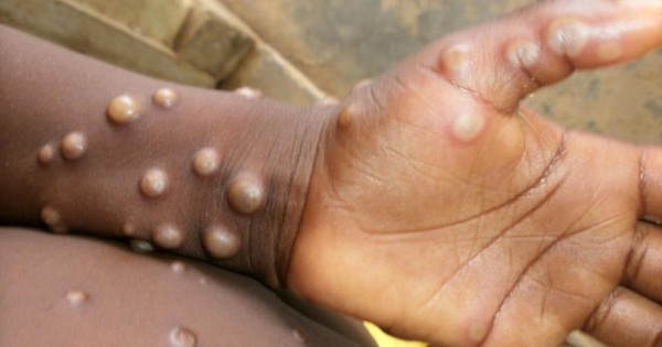 There have been 10 deaths from monkeypox in endemic areas