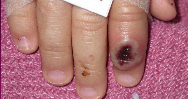 Phát hiện bệnh nhi nhiễm đậu mùa khỉ đầu tiên trên thế giới