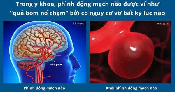 Người đàn ông bị phình động mạch não giữa kích thước "khổng lồ" Người đàn ông bị phình động mạch não giữa kích thước "khổng lồ"