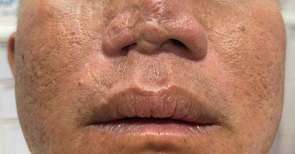 Điều trị miễn phí cho người co rút do bỏng, mất da