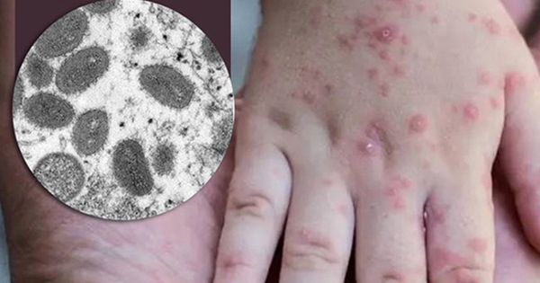 thumbnail - Tốc độ lây nhiễm của đậu mùa khỉ và SARS-CoV-2 khác nhau thế nào?