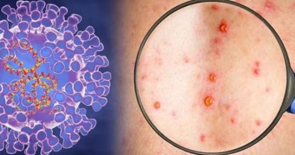 Số mắc đậu mùa khỉ tăng mạnh, Bộ Y tế đưa ra 3 tình huống chống dịch