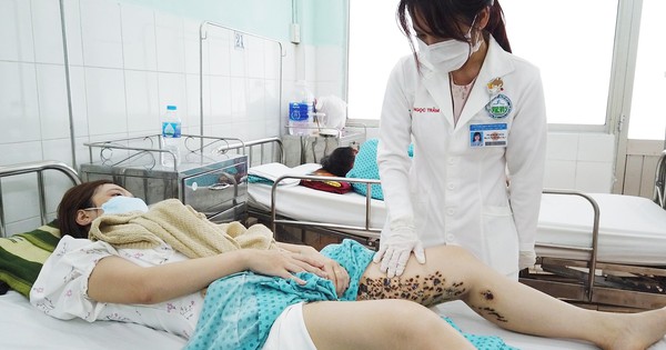 "Tổ ong" phá vùng đùi cô gái sau khi đốt điện tại spa "Tổ ong" phá vùng đùi cô gái sau khi đốt điện tại spa