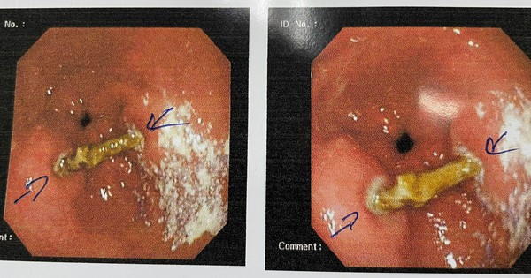 Ớn hình ảnh người đàn ông bị thủng bao tử vì xác trà