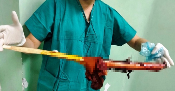 Ớn lạnh người đàn ông bị cây gỗ đâm xuyên từ trước ngực ra sau lưng