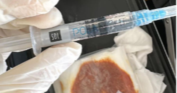 Tiêm filler trị thâm, nữ khách hàng bị tiêm ôxy già vào mắt