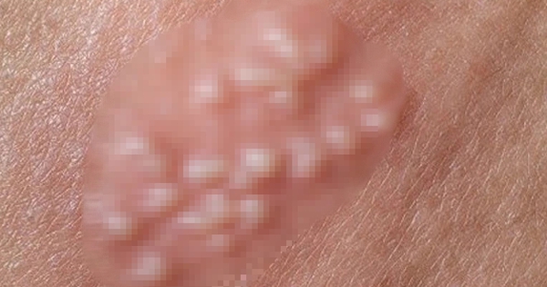 Thiếu niên 15 tuổi nhập viện với "vùng kín" sưng tấy sau khi thử "mùi đời"