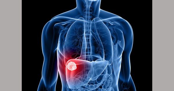 6 dấu hiệu cảnh báo ung thư gan nhiều người bỏ sót