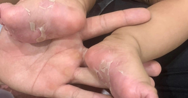 Bé trai 3 tháng tuổi mắc bệnh giang mai bẩm sinh