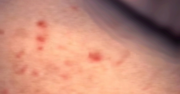 Người đàn ông có bạn tình cả 2 giới, bị lở loét vùng kín