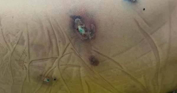 Đá bóng sân bùn đất, bé trai 10 tuổi sốc nhiễm khuẩn nặng do vi khuẩn hiếm gặp