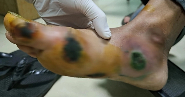 Bệnh nhân đái tháo đường loét bàn chân do thói quen thường gặp