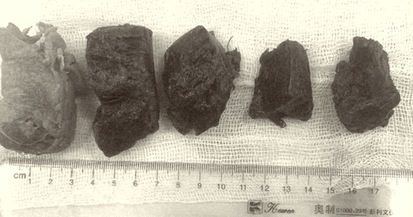 Cấp cứu tắc ruột do món ăn truyền thống ngày Tết