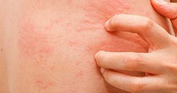 Vì sao bệnh ngoài da tăng mạnh do nồm ẩm?