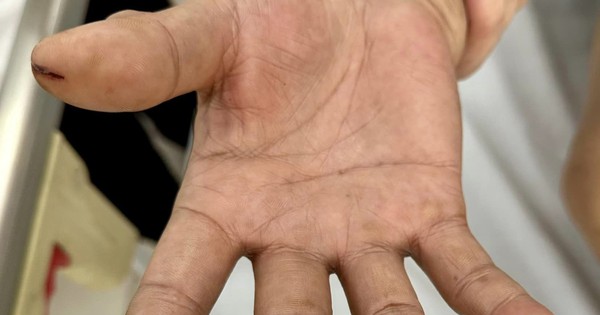 Đột quỵ não không đến bệnh viện, người nhà chích máu ngón tay khiến người đàn ông suýt chết