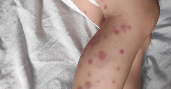Bé trai lộ bệnh như bị "bạo hành" khiến cha mẹ một phen sợ hãi