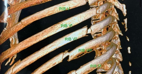 Cú té làm người đàn ông gãy hàng loạt xương sườn, suy hô hấp