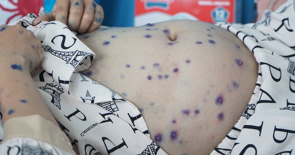 Thủy đậu vào mùa, nhiều ca nặng