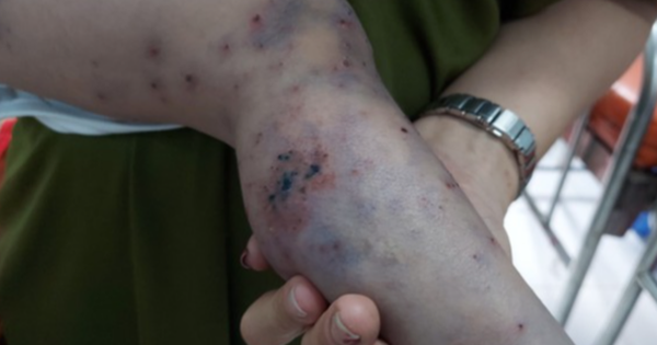 Phân bổ 6.000 chai thuốc đặc trị tay chân miệng cho bệnh viện