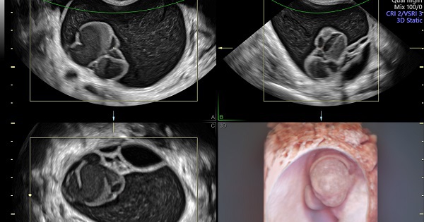 Hút cả lít dịch cứu người phụ nữ đi tiểu 15 lần mỗi đêm