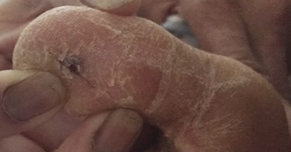 Người phụ nữ bất ngờ bị cứng hàm vì căn bệnh quen thuộc