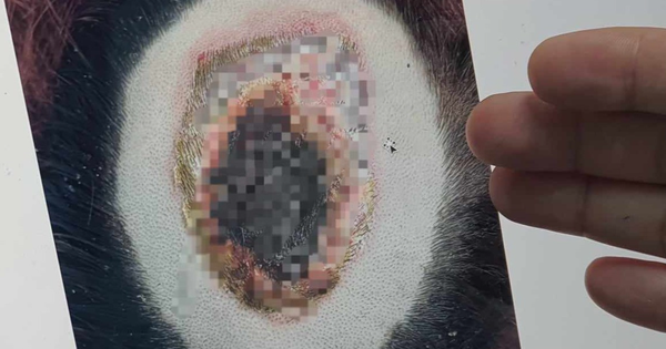 Tẩy tóc khiến cả mảng da đầu cô gái trẻ loét, chảy mủ