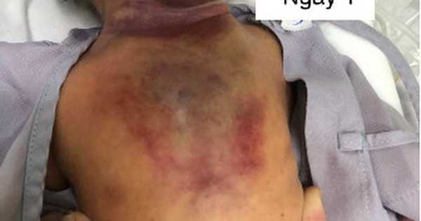 Bệnh hiếm khiến bé gái 1 ngày tuổi hẹp đường thở, suy hô hấp