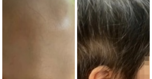 Bé gái 7 tuổi rụng tóc toàn đầu, hồi phục kỳ diệu sau một năm