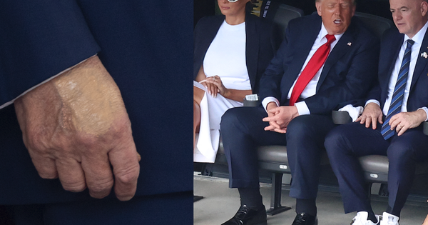 Nhà Trắng thông báo Tổng thống Donald Trump mắc suy tĩnh mạch mạn tính