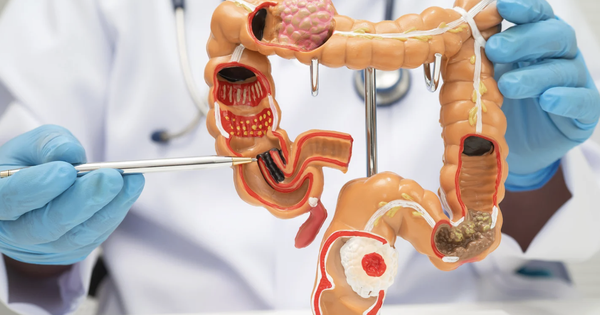 Đau bụng kéo dài, cụ bà 72 tuổi nhập viện trong tình trạng viêm phúc mạc toàn thể