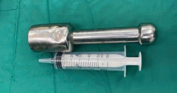 Thiếu niên 15 tuổi mắc kẹt chày kim loại dài 18 cm ở trực tràng