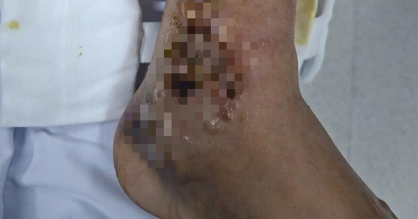 Đắp thuốc, một người đàn ông suýt mất chân