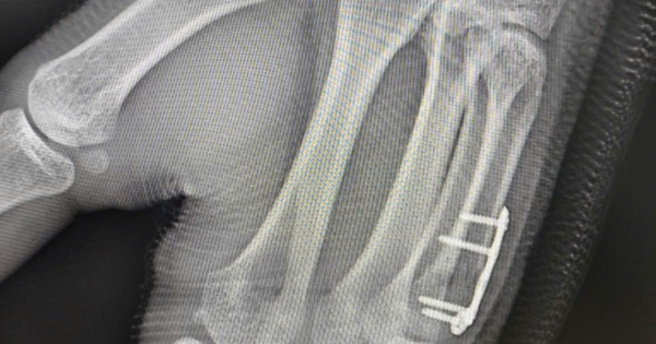 Nam sinh gãy xương bàn tay sau cú đấm boxing