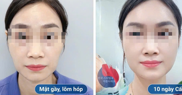 Hóp má, teo mô sau thẩm mỹ: Biến chứng “âm thầm” nhưng nguy hiểm