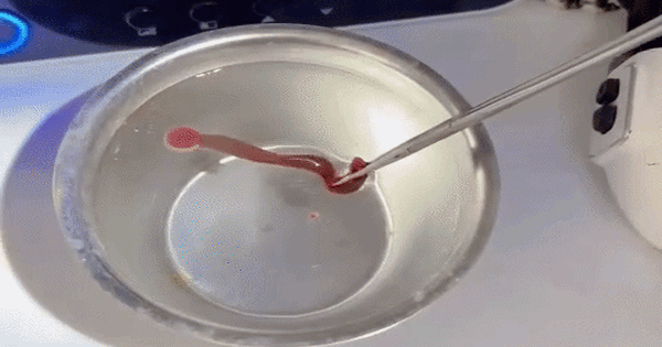 Rùng mình với dị vật 