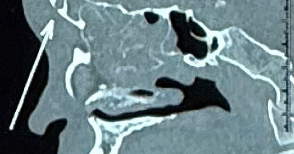 Tưởng chỉ viêm xoang đơn giản, nam thanh niên suýt mất mạng vì bị biến chứng