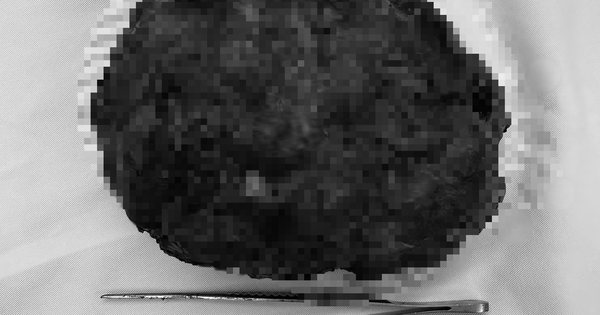 Cô gái trẻ về nước mổ u vú 17 cm, giữ được “vòng một”