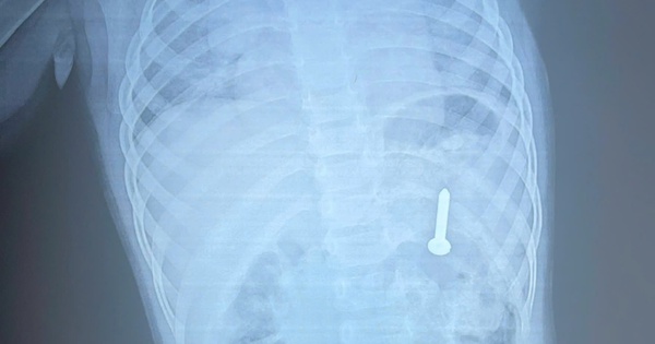 Dị vật sắc nhọn nằm trong dạ dày bệnh nhi 21 tháng tuổi