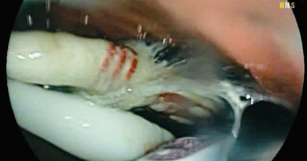 Người đàn ông nuốt cùng lúc 3 bàn chải đánh răng vào bụng