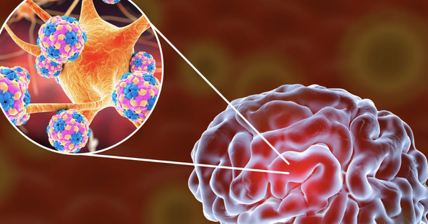 Bệnh nhi 11 tuổi bị viêm não mô cầu đã không qua khỏi