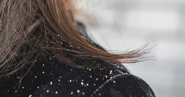 Chuyên gia cảnh báo: 50% dân số từng bị gàu nhưng điều trị chưa đúng