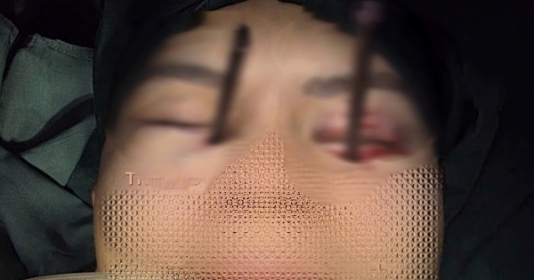 Cứu nam thanh niên bị 2 chiếc đũa đâm sâu vào 2 hốc mắt